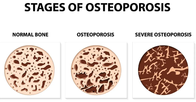 Osteoporosis: Penyakit Keropos Tulang yang Perlu Diwaspadai