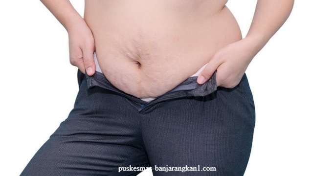 8 Bahaya dan Dampak Negatif dari Obesitas